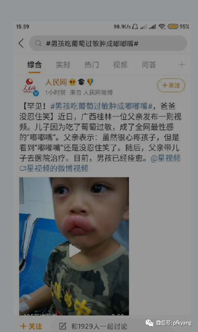 男孩吃葡萄過敏腫成嘟嘟嘴怎么回事？畫面詳情曝光網友忍不住笑了(圖3)